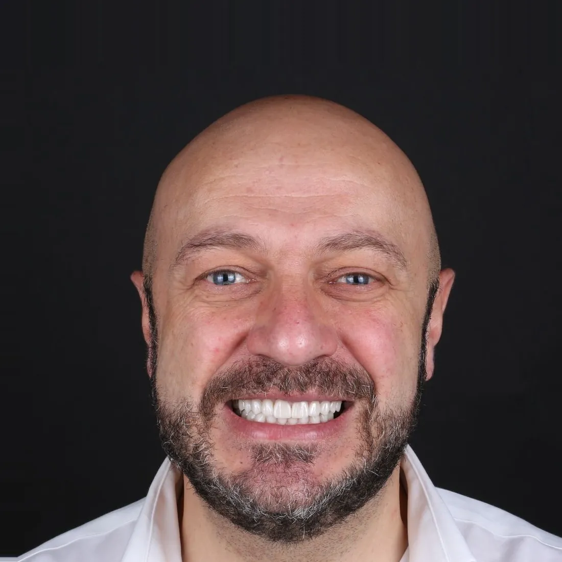 Patient d’Unique Cliniq après le traitement par facettes