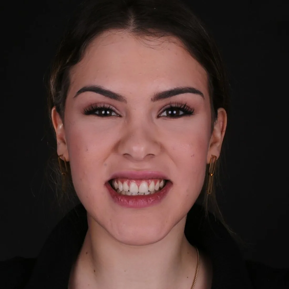 Avant le traitement par facettes chez Unique Cliniq