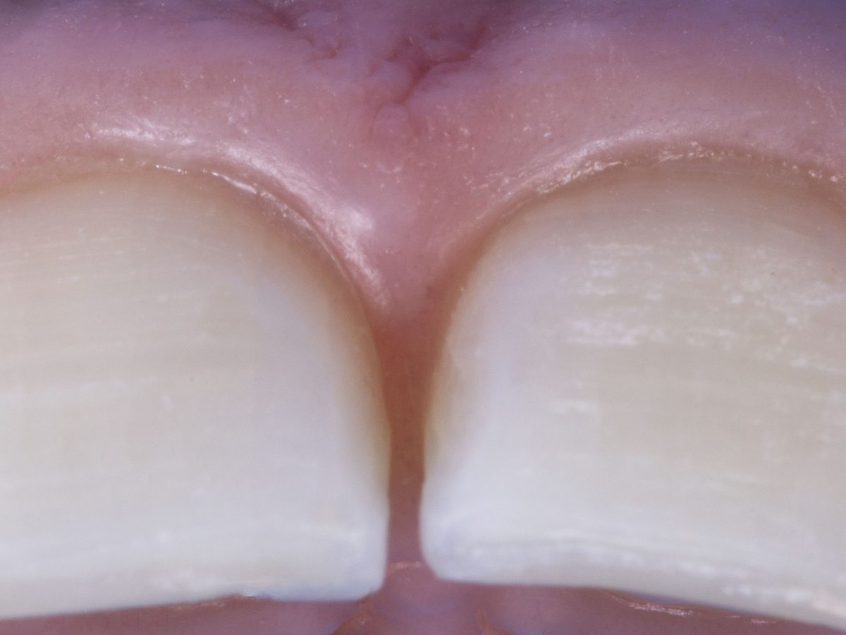 Dientes anteriores y línea de la encía antes de un tratamiento de cirugía estética de encías